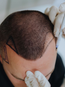 Hairline Transplant