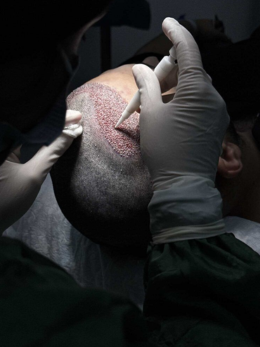 Hair Transplant