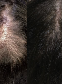 Medical Hair Loss Treatment