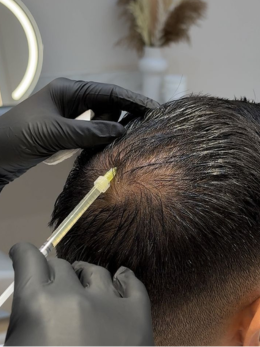 PRP for Hair Loss Therapy