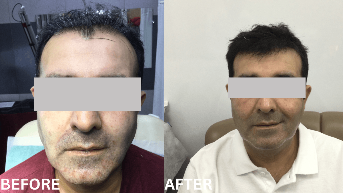 Hair Transplant 1