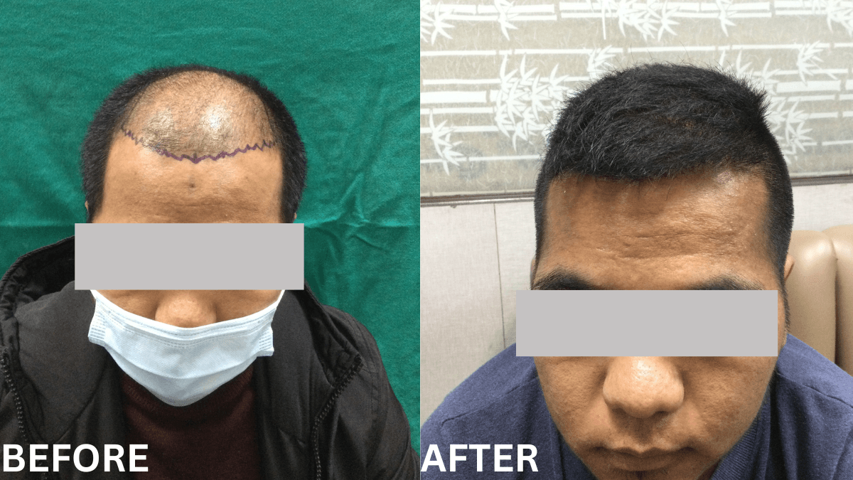 Hair Transplant 2