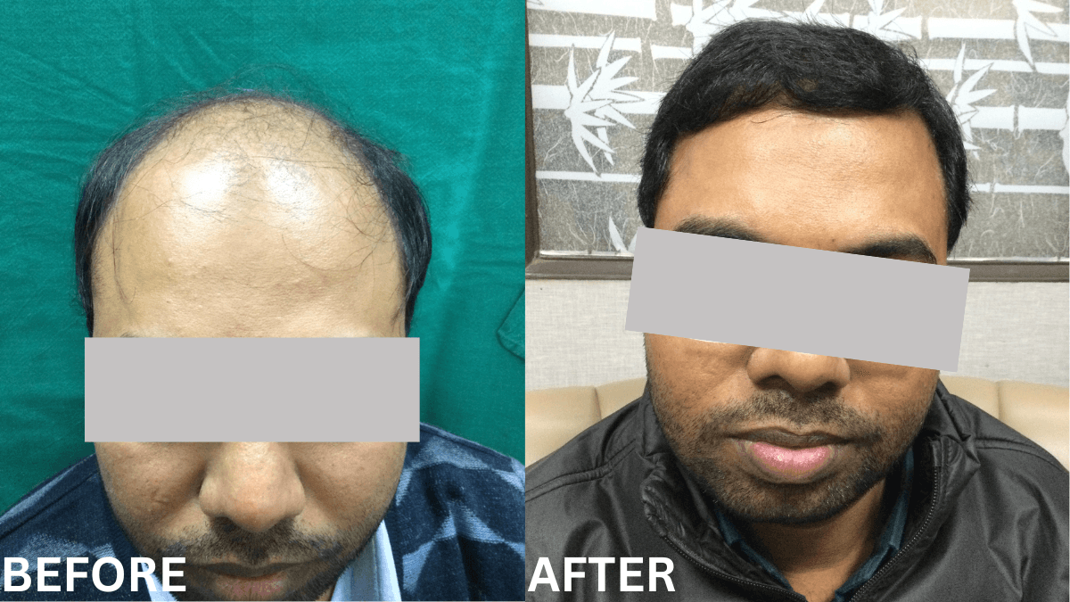 Hair Transplant 3