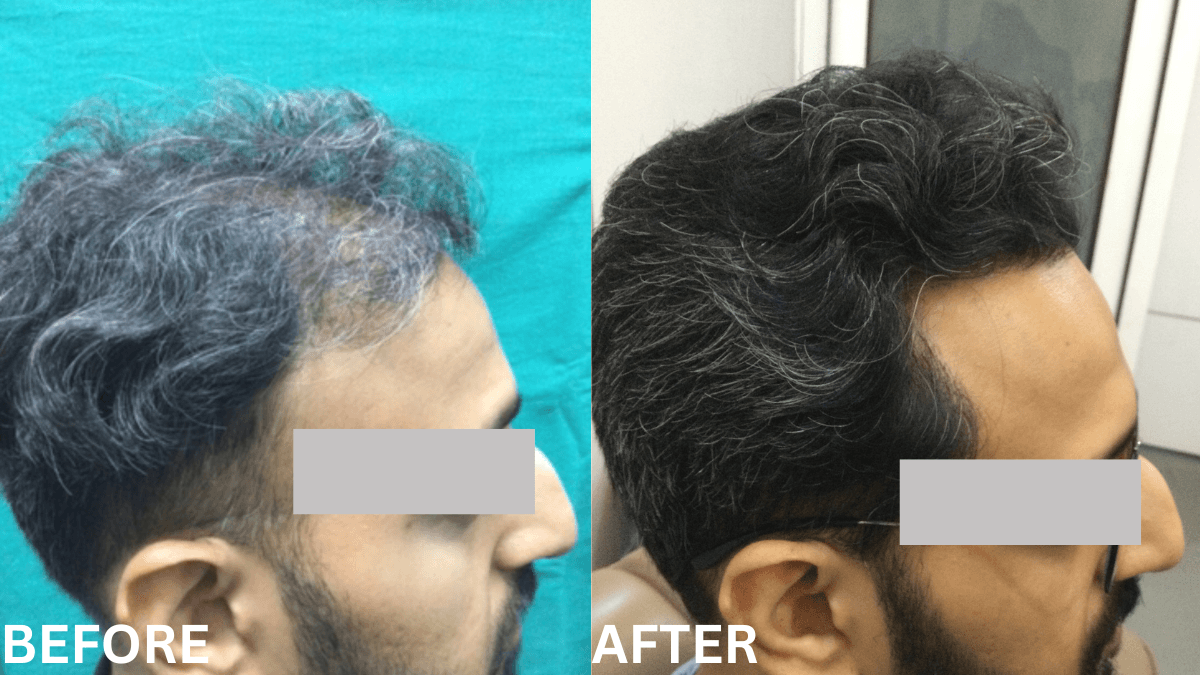 Hair Transplant 4