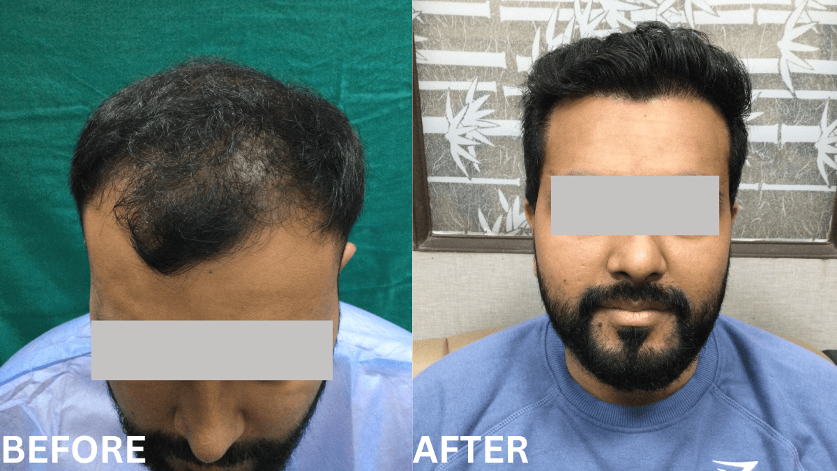 Hair Transplant 5