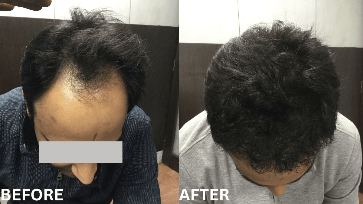Hair Transplant 6